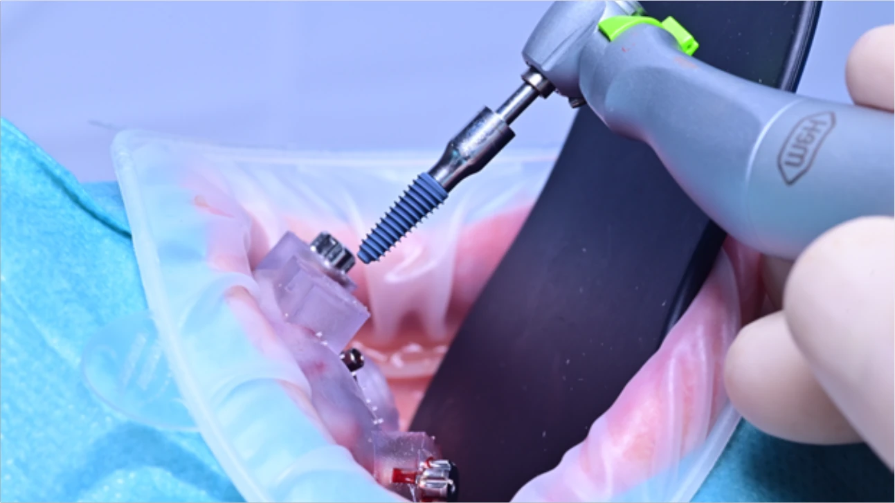 Pose d’un implant dentaire à l’aide d’un contre-angle chirurgical et d’un guide de forage, en conditions opératoires stériles