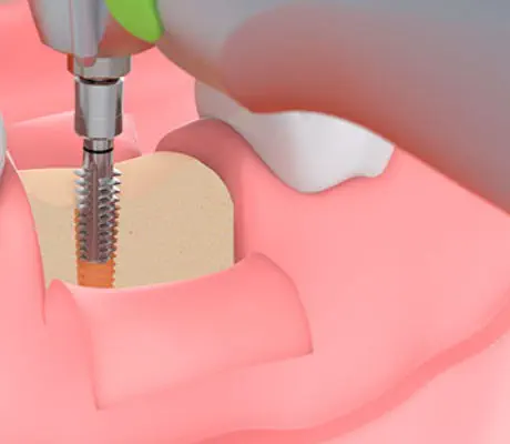 pose d’implant dentaire dans l’os alvéolaire en chirurgie guidée